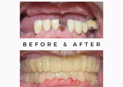 No Teeth Dental Treatment