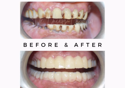 Teeth Stain Dental Treatment