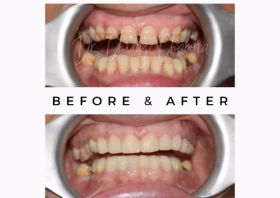 Implant Dental India Kandivali East, Mumbai