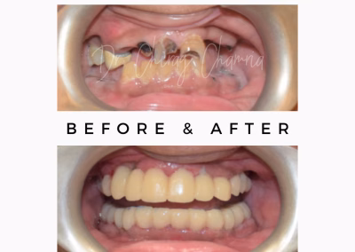 Crooked Broken Teeth