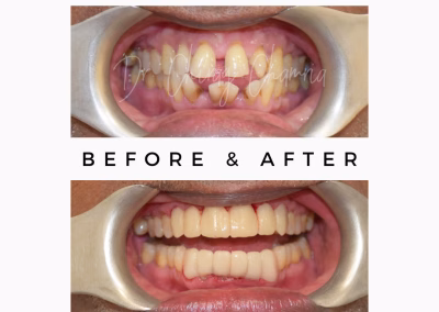 Before After Smile Makeover