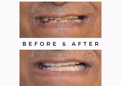 Smile Makeover in One Day