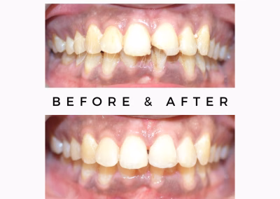 Single tooth bonding